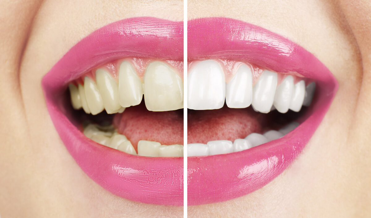 At Home Teeth Whitening Before and After