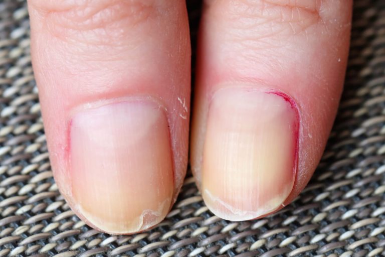 How to Prevent Peeling Nails KeyGlam